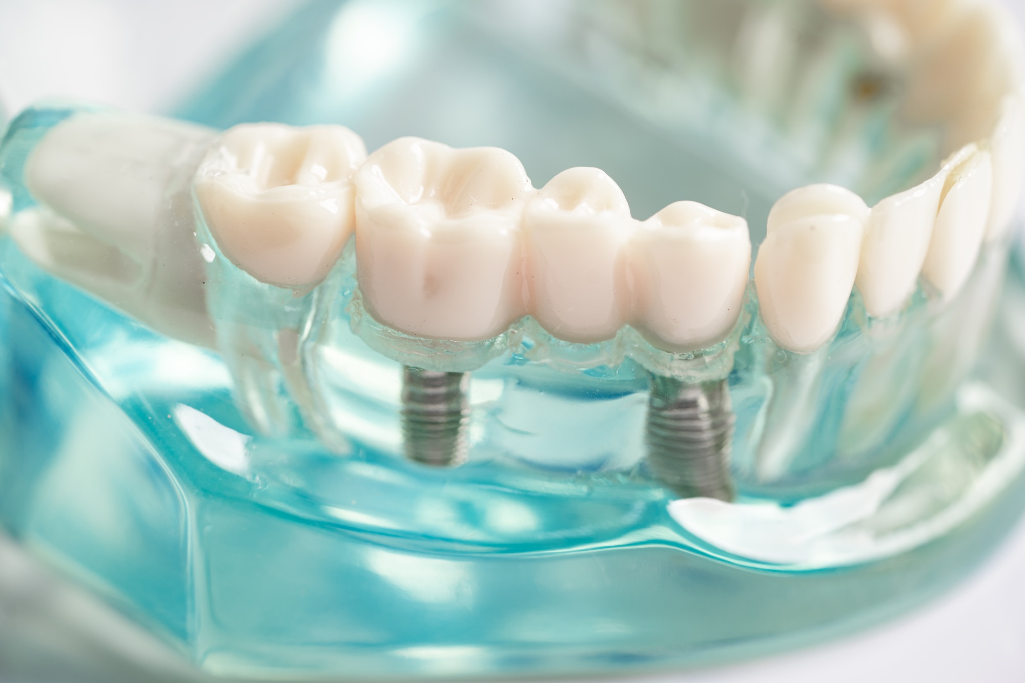 ▷ Implantology in Valencia | Clínica Dental La Reina