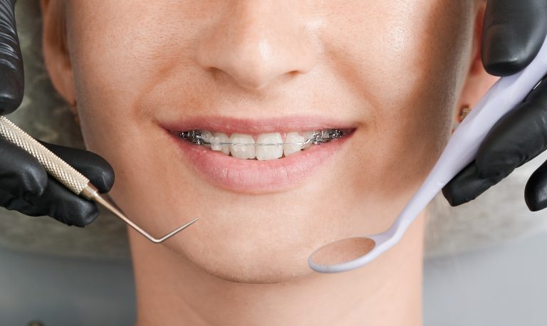 como limpiar los brackets transparentes