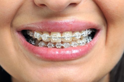 close-up-of-ceramic-and-metallic-braces-on-teeth-2025-03-08-16-36-56-utc-1024x680