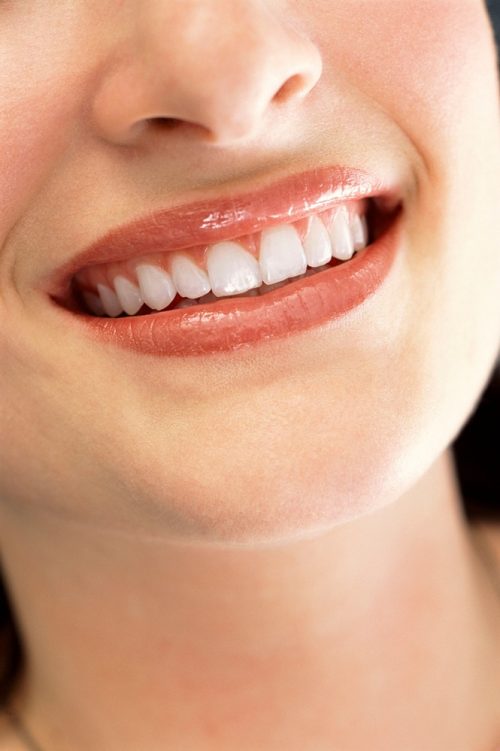 Tratamiento de carillas dentales para mejorar la sonrisa